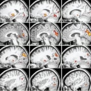 Acupuncture points FMRI