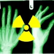 CT radiation risks Xray