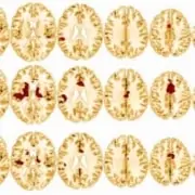 Insomnia acupuncture